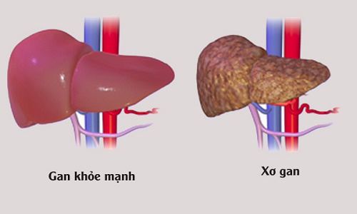 các giai đoạn tiến triển của xơ gan