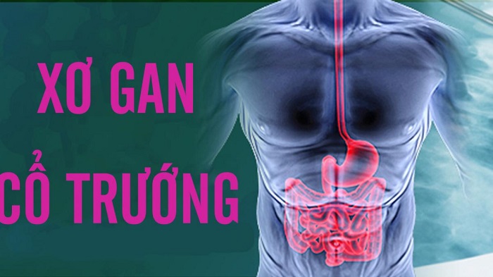 Xơ gan cổ trướng là căn bệnh nguy hiểm