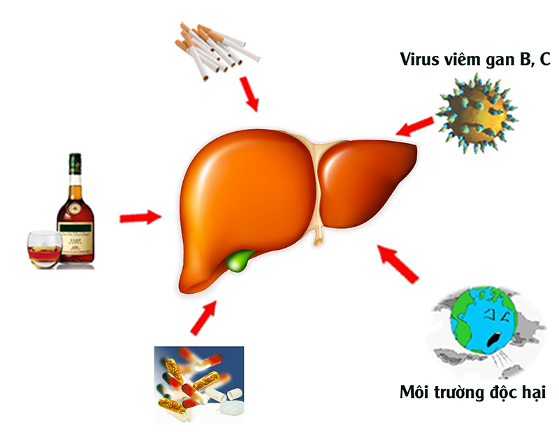 Có rất nhiều tác nhân gây nên bệnh xơ gan cổ trướng