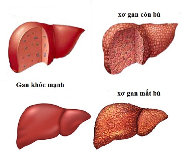 Xơ gan tiến triển (xơ gan mất bù) là giai đoạn cuối của bệnh xơ gan