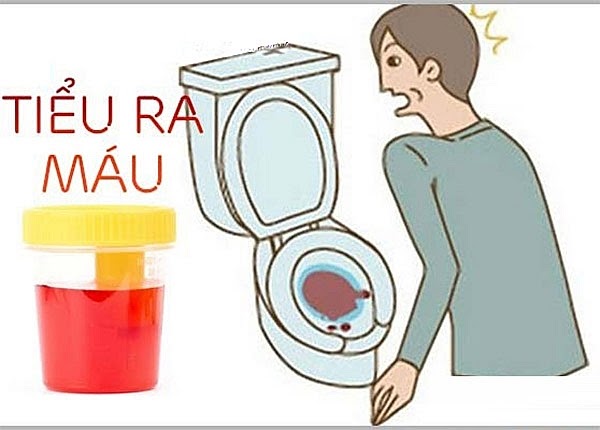 Nước tiểu đục hoặc có máu là triệu chứng phổ biến của bệnh viêm bàng quang