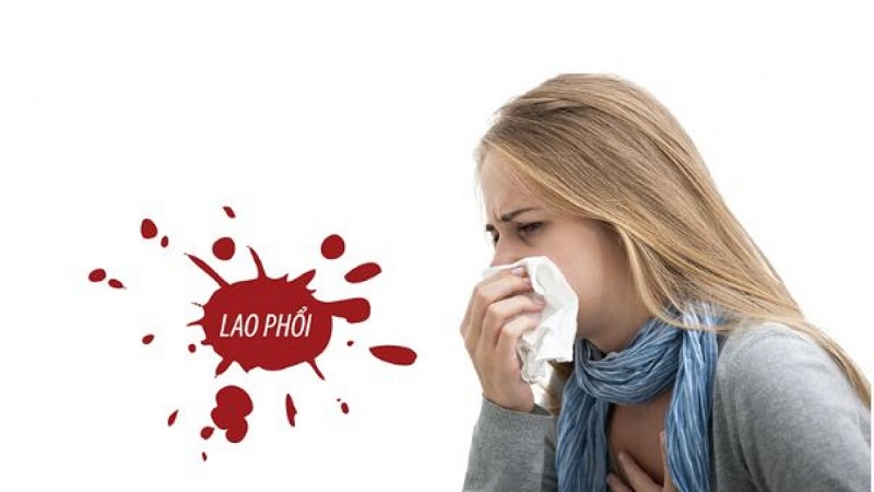 Lao phổi là thể lao phổ biến nhất