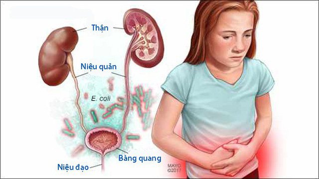 Hầu hết các bệnh viêm bàng quang là do vi khuẩn E. coli gây ra. Loại vi khuẩn này có tự nhiên trong ruột già.