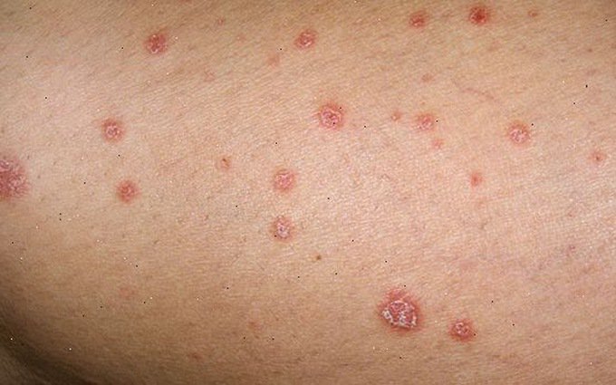 Neisseria gonorhoeae gây bệnh lậu là song cầu bắt màu Gram âm.