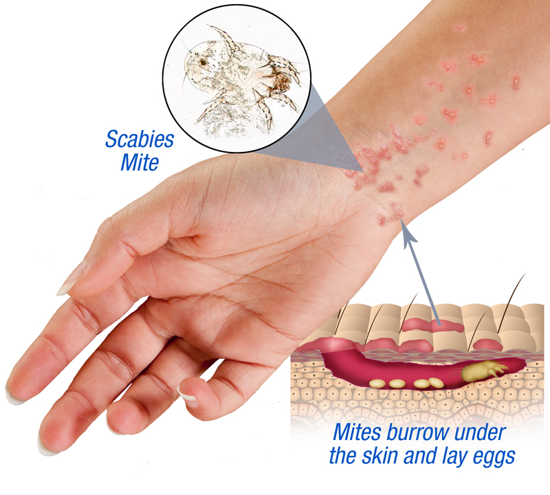 Nguyên nhân gây bệnh ghẻ là Sarcoptes scabiei (Hominis - cái ghẻ)