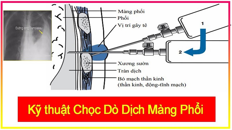 Kỹ thuật chọc dò dịch màng phổi