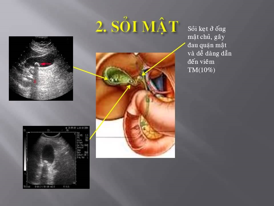 Siêu âm giúp phát hiện sỏi mật vì là phương pháp không xâm lấn, dễ áp dụng
