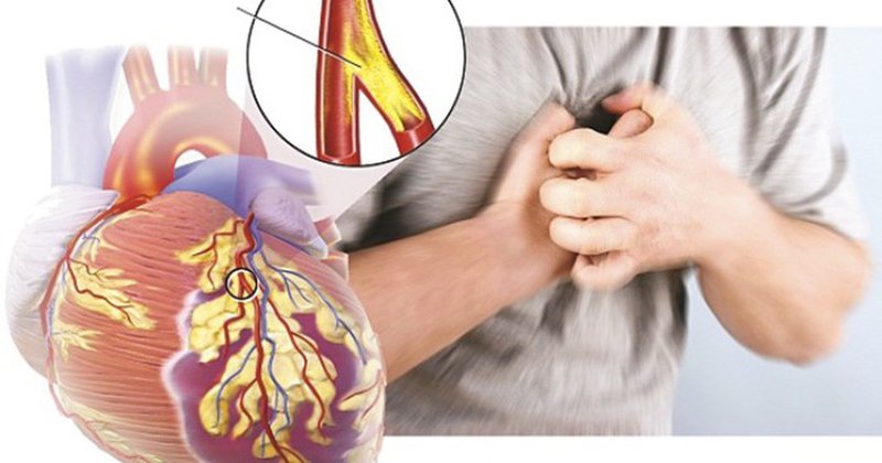 Cơn đau thắt ngực là triệu chứng điển hình của bệnh mạch vành