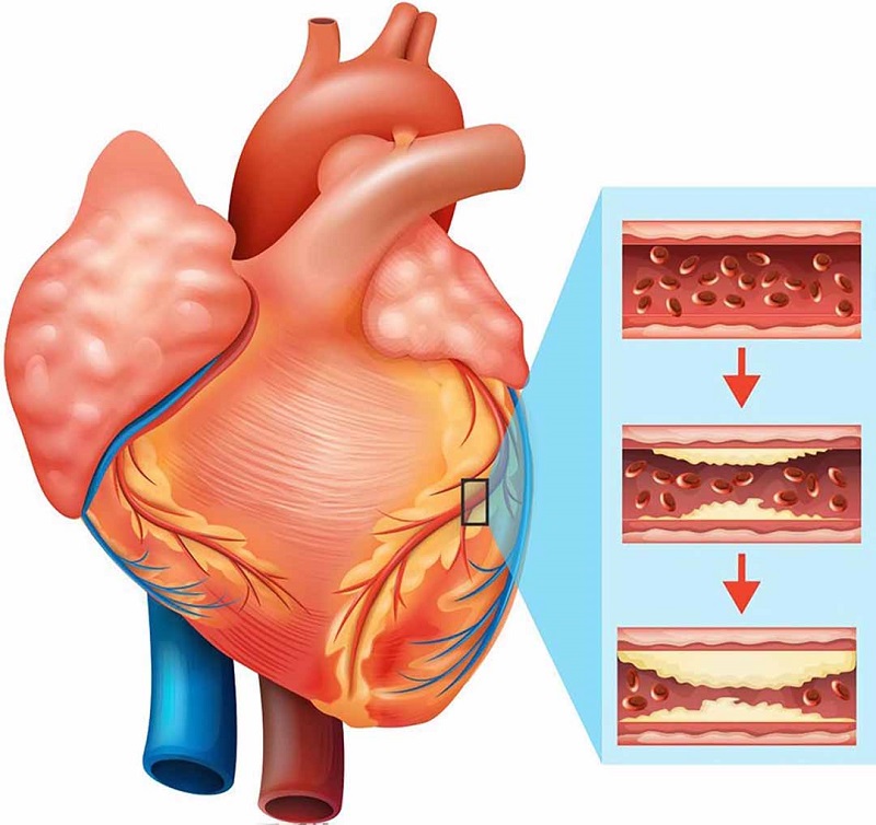 Bệnh mạch vành do mảng vữa xơ