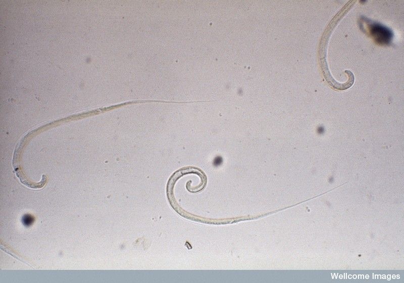 Giun Dracunculus medinensis là căn nguyên gây bệnh