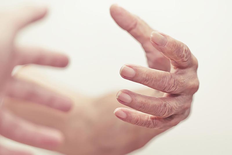 Đầu tiên là run các ngón tay sau đó có thể run cơ vùng mặt rồi tiến triển thành múa giật ở các chi