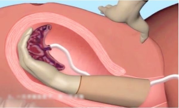 Lấy thai và lấy rau