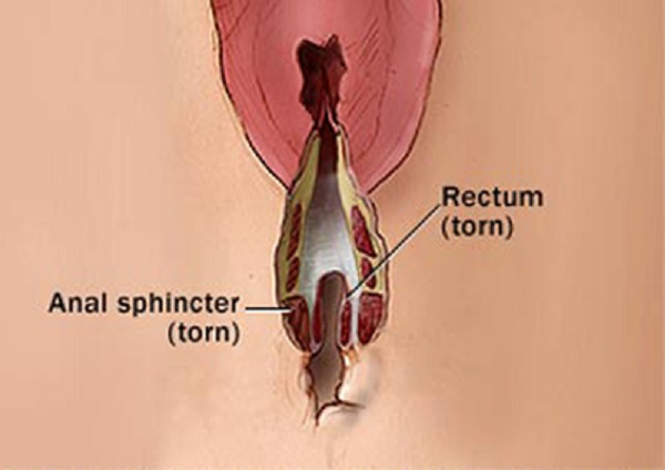 Rách đường sinh dục