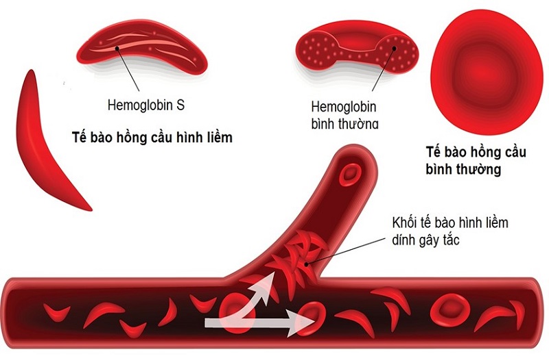 Bệnh hồng cầu hình liềm (SCD), một bệnh di truyền do rối loạn lặn Mendel