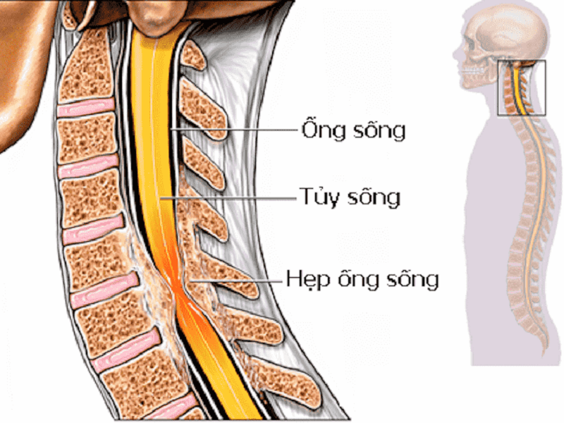 hẹp ống sống khi được chẩn đoán cần điều trị sớm