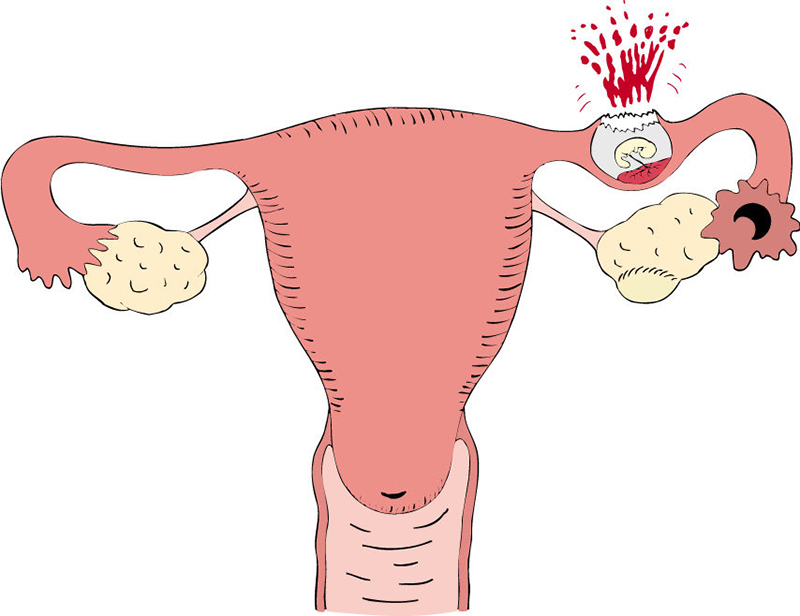 Đau bụng dưới ở phụ nữ là dấu hiệu của bệnh gì và có nguy hiểm không