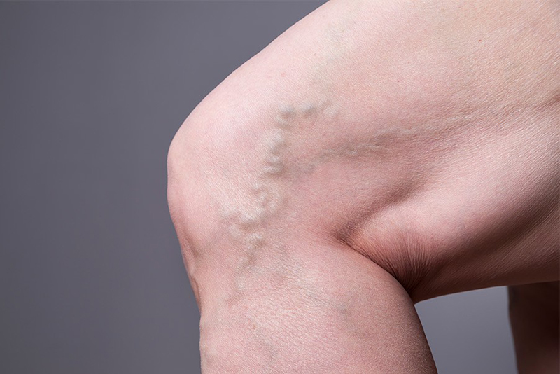 Những đường gân xanh nổi ngoằn ngoèo trên chân gây mất thẩm mỹ cho cơ thể