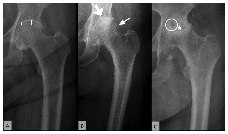 4. Các Biến Chứng Thoái Hóa Khớp Háng