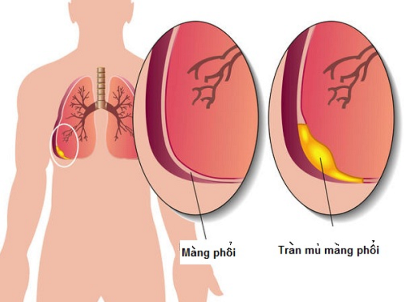 Lao Màng Phổi: Tìm Hiểu Chi Tiết Về Nguyên Nhân, Triệu Chứng và Cách Điều Trị Hiệu Quả