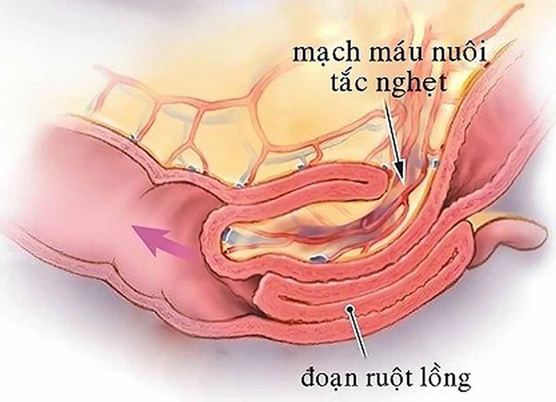 Bệnh Lao Ruột Có Chữa Được Không? Giải Đáp Toàn Diện và Hiệu Quả