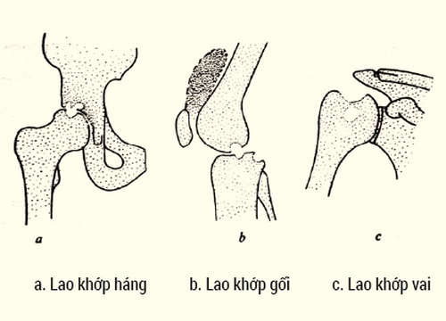 Dấu hiệu bệnh lao xương