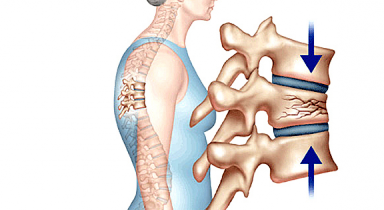 4. Phương pháp điều trị xẹp đốt sống cổ