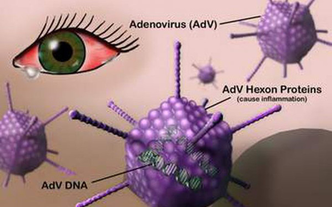 Viêm kết mạc virus: Triệu chứng, nguyên nhân và cách điều trị hiệu quả