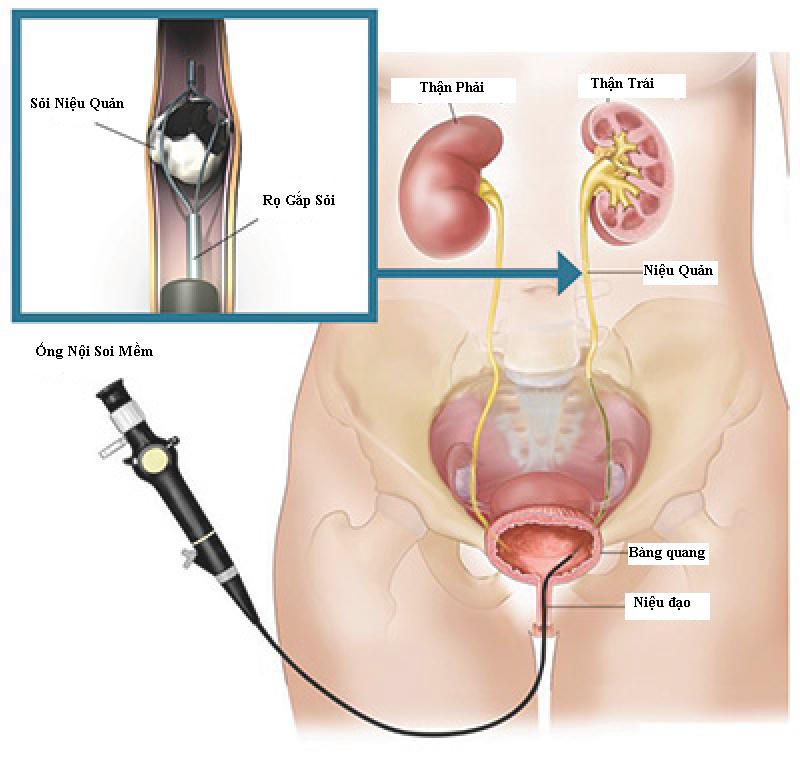 4. Lối Sống Phòng Ngừa Bệnh Sỏi Thận