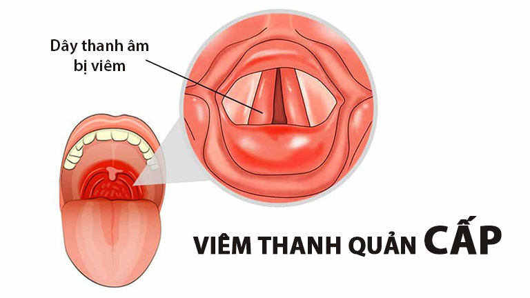 Viêm thanh quản cấp: Nguyên nhân, triệu chứng và phương pháp điều trị hiệu quả