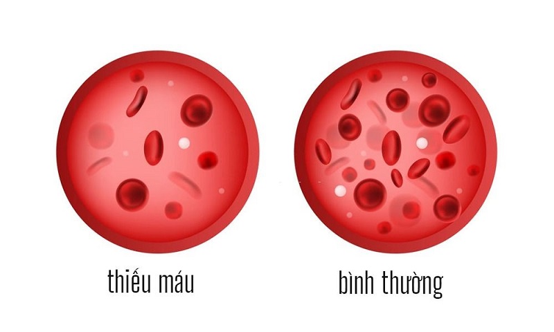 Thiếu máu do thiếu vitamin B12