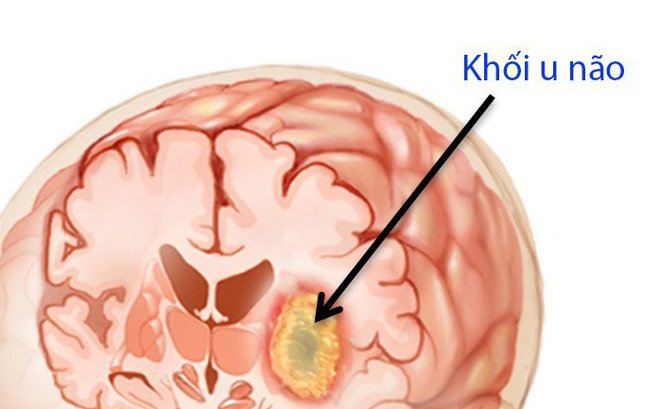 3. Chẩn Đoán Ung Thư Não Di Căn