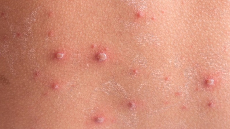 6. Phòng Ngừa Herpes Zoster