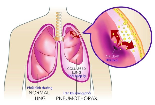 Triệu Chứng Ung Thư Màng Phổi