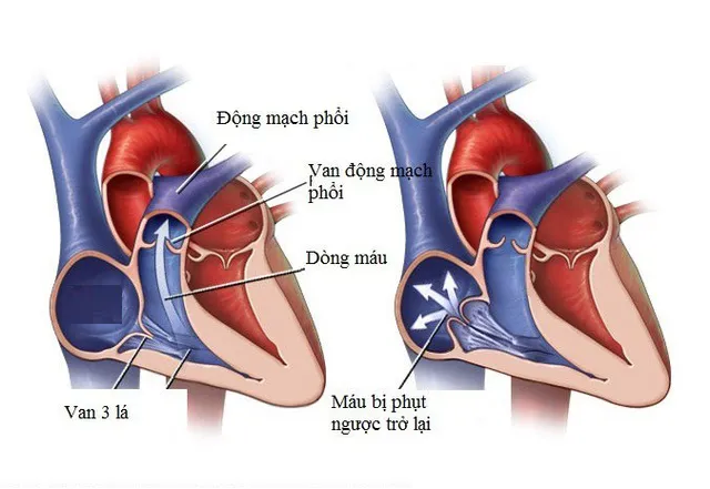 4. Chẩn Đoán Hở Van Tim 2 Lá và Hở Van 3 Lá