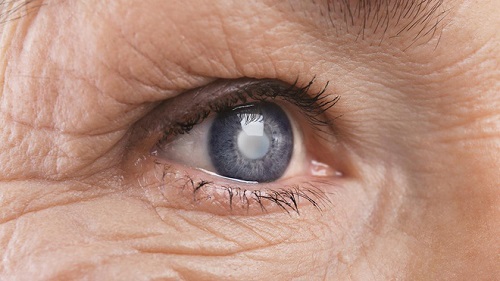 Glôcôm căn bệnh nguy hiểm khó nhận diện, dễ mù lòa | Medlatec