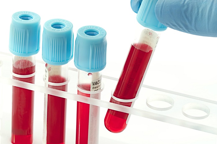 Ý nghĩa của các kết quả trong xét nghiệm máu - Medlatec.vn