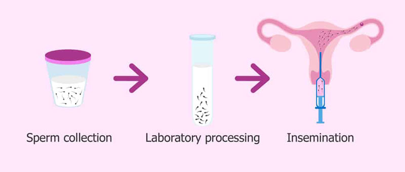 Kinh nghiệm đi bơm tinh trùng đạt tỷ lệ thành công cao