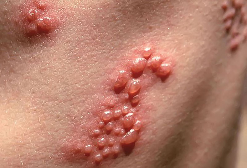 Herpes là bệnh gì, nguyên nhân và cách điều trị | Medlatec