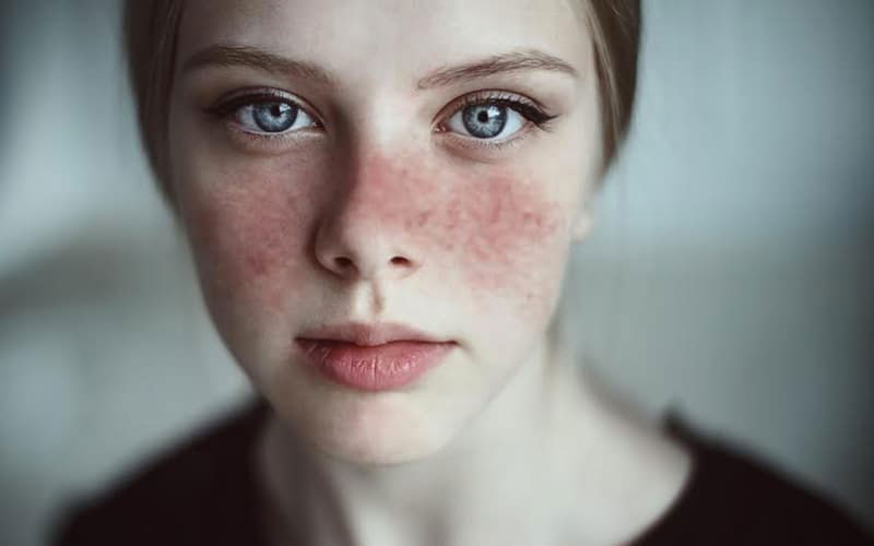 Kết quả hình ảnh cho Lupus ban đỏ là bệnh gì