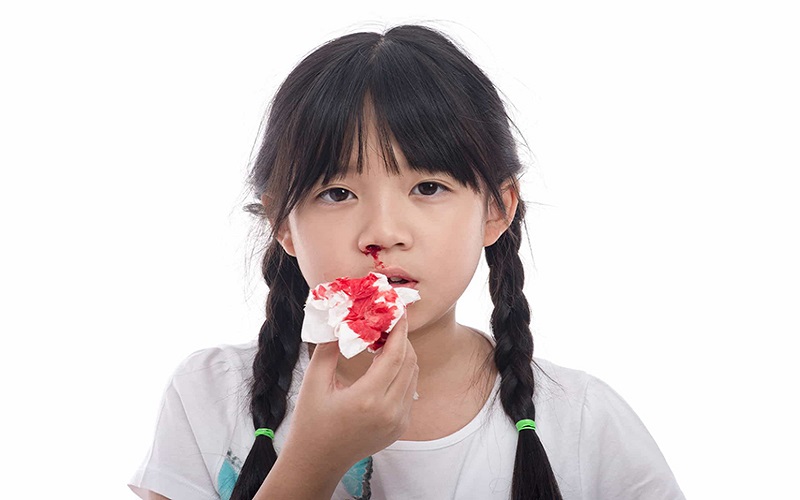 Chảy máu mũi: Nguyên nhân cách xử lý và phòng ngừa