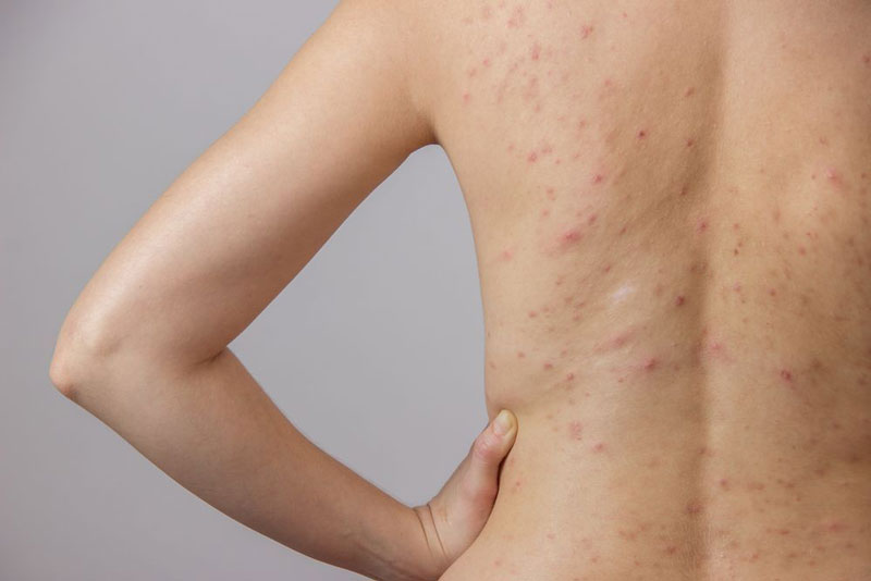 Viêm da tiết bã: Nguyên nhân và phương pháp điều trị hiệu quả