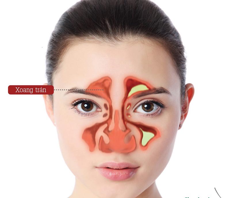 Viêm xoang: Nguyên nhân, triệu chứng và cách điều trị