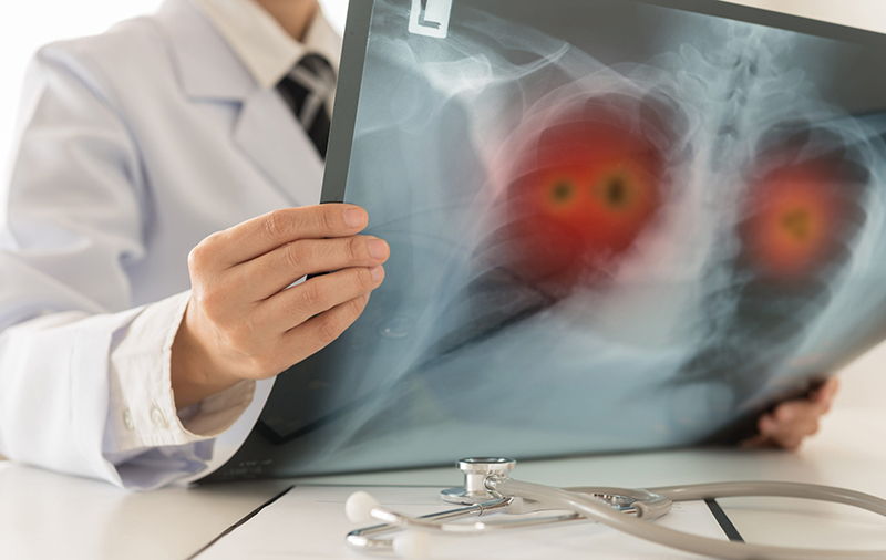 Làm sao để nhận biết dấu hiệu ung thư phổi từ sớm? | Medlatec