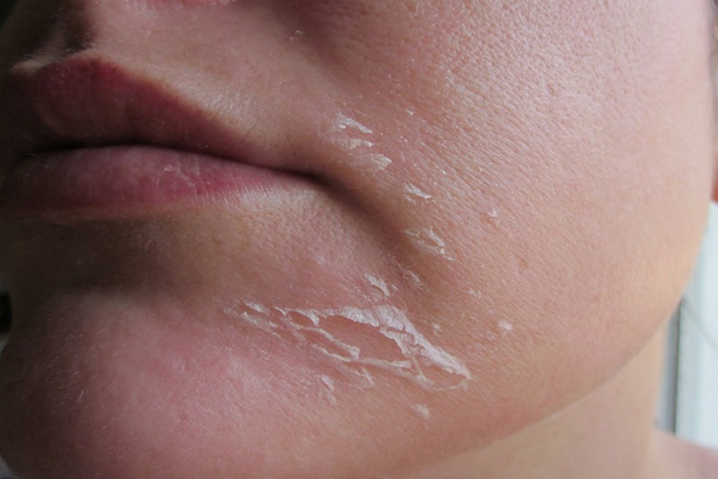 Điểm danh những nguyên nhân bong tróc da mặt và cách khắc phục hiệu quả
