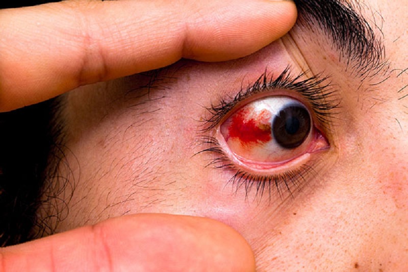 Cách làm tan máu ở trong mắt hiệu quả và thực hiện được tại nhà