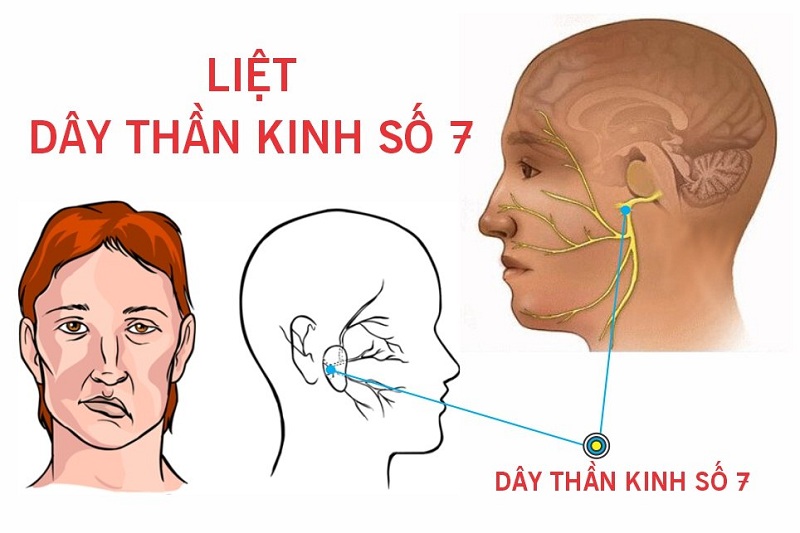 Bạn nên biết: Liệt dây thần kinh số 7 có thể chữa khỏi không