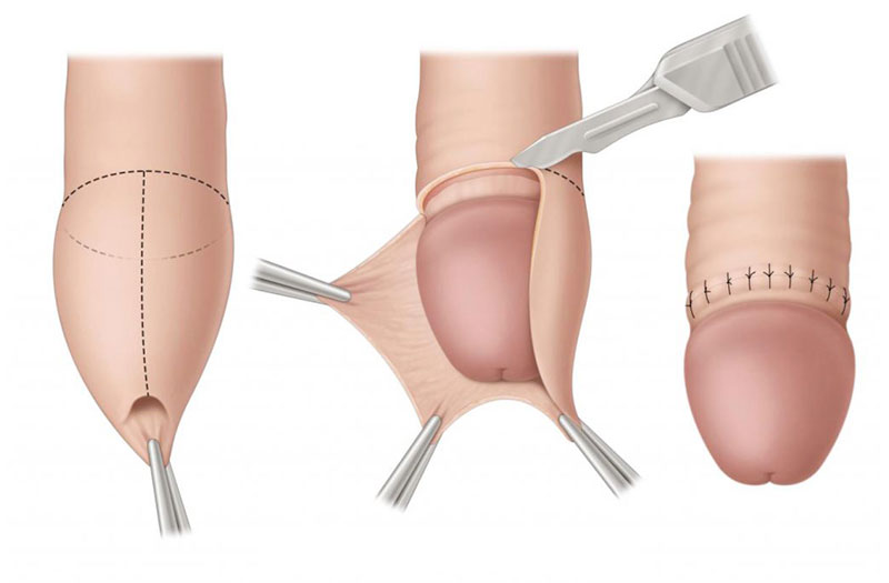 Dấu hiệu nhiễm trùng sau khi cắt bao quy đầu bạn không nên chủ ...