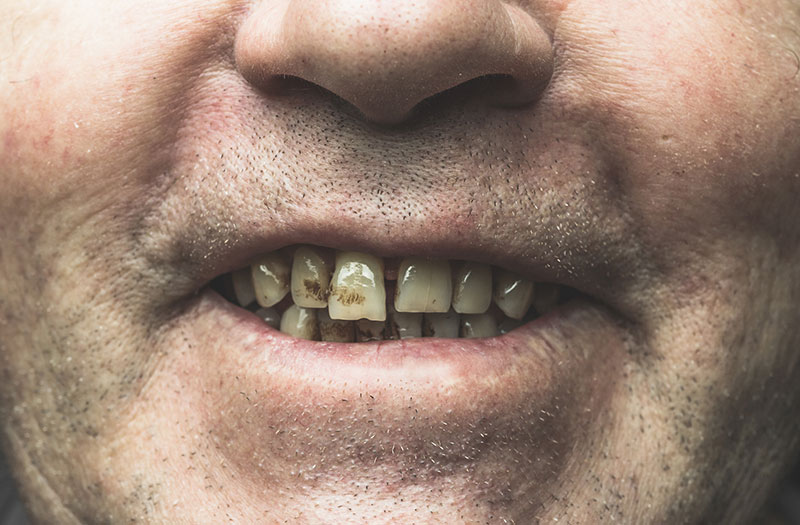 Bạn có biết hút thuốc ảnh hưởng đến răng miệng như thế nào?