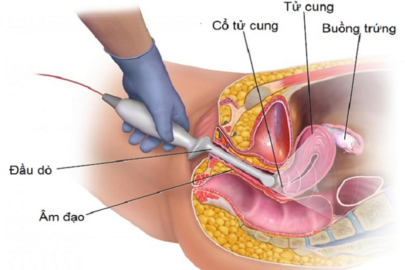 Siêu âm buồng trứng