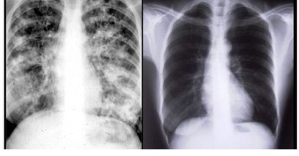 Chụp X-quang có phát hiện được ung thư phổi không? | Medlatec